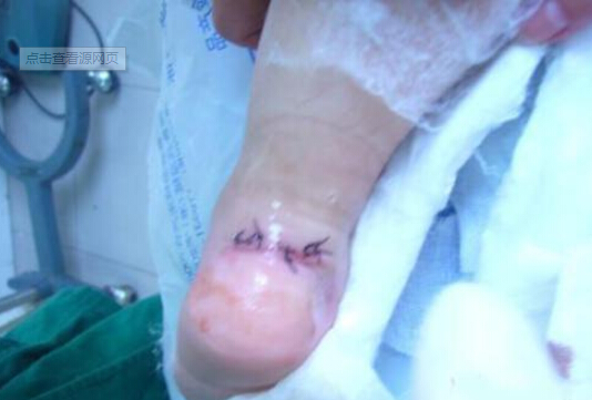 鋸片割傷左腳